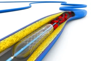 Bioresorbabale Extrusion, PLLA, PLGA 